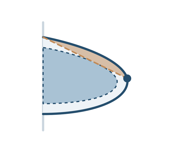 Protesis ergonomica: transicion intermedia